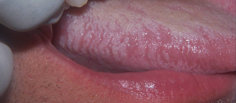 Лейкоплакия полости рта